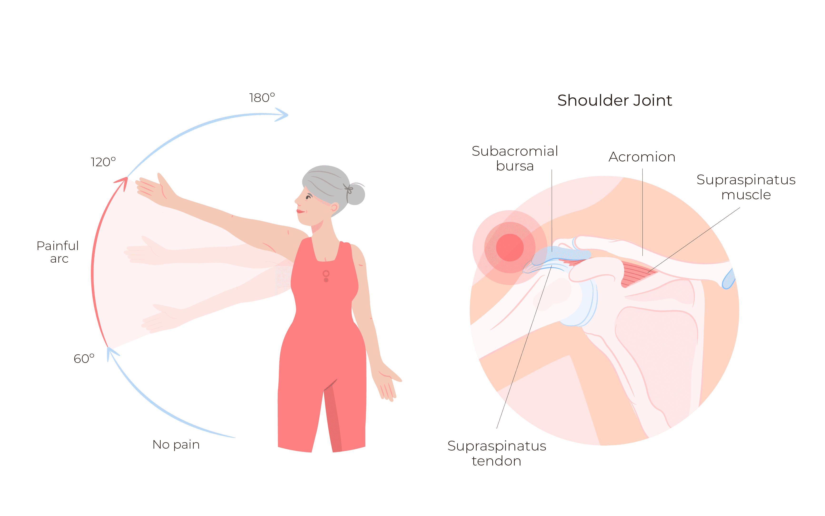shoulder impingement