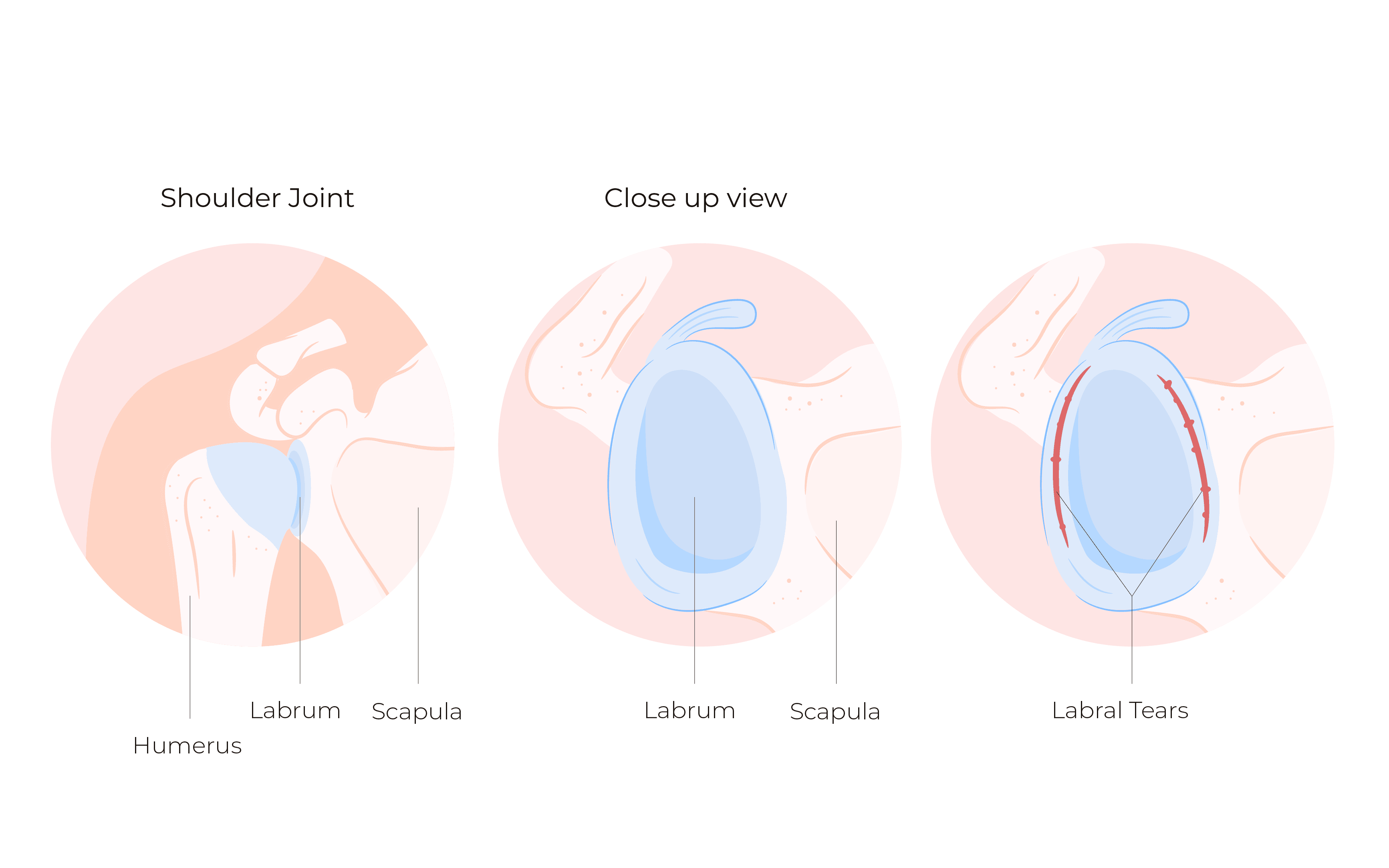 labral tear in shoulder