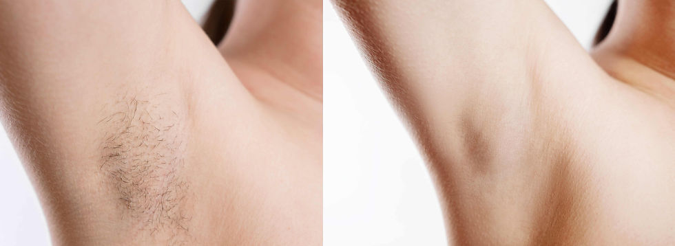 laser hair removal saskatoon before and after