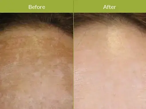 chemical peel saskatoon before and after