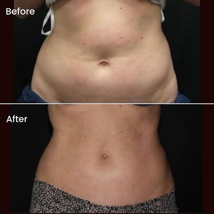 body contouring near me saskatoon