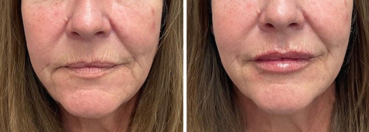 lip fillers saskatoon