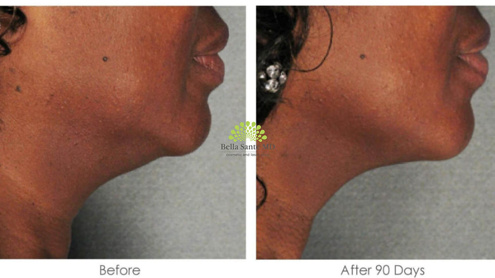 Ultherapy Treatment in chin: Before and After
